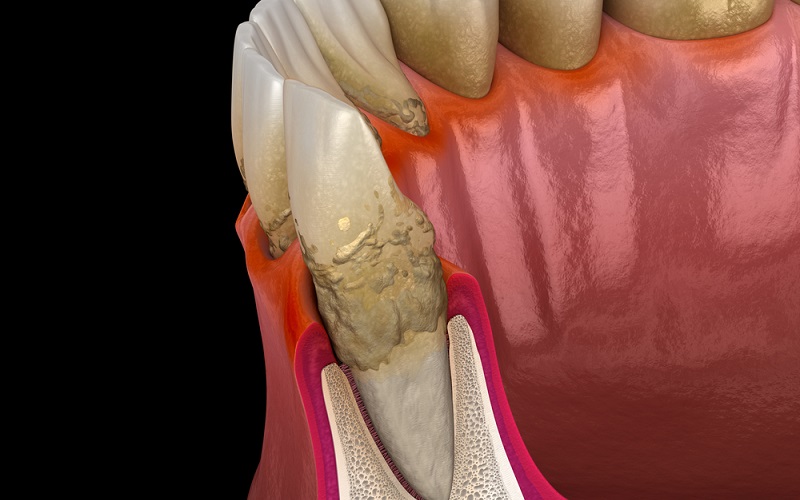 歯周病とプラーク